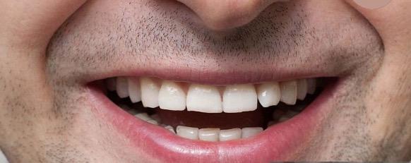 Smilekit menta blanqueadora dental