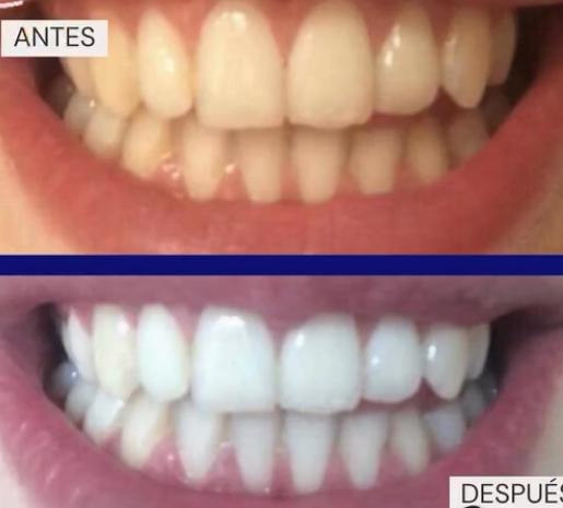 Smilekit menta blanqueadora dental