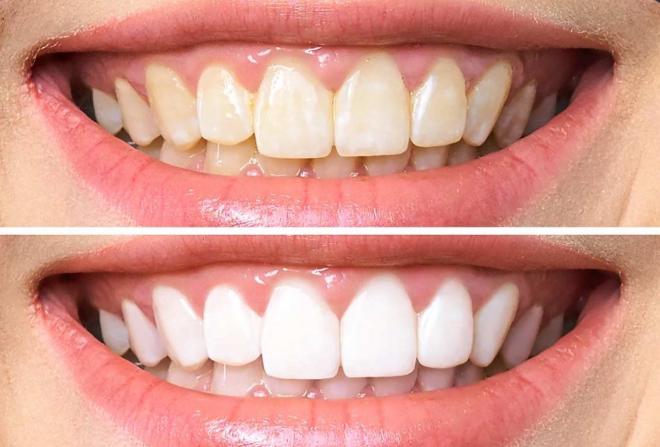 Smilekit menta blanqueadora dental