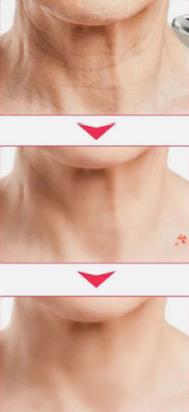 MASAJEADOR FACIAL HY69 (PARA ELLAS Y ELLOS)